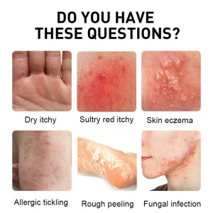 NESLEMY™ Psoriasis Cure Cream 21 NESLEMY™ Psoriasis Cure Cream