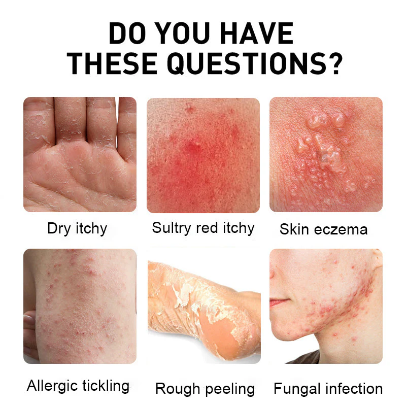 NESLEMY™ Psoriasis Cure Cream 11 NESLEMY™ Psoriasis Cure Cream