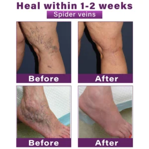 CVREOZ® Polidocanol Nano Varicose Vein Patch 17 CVREOZ® Polidocanol Nano Varicose Vein Patch