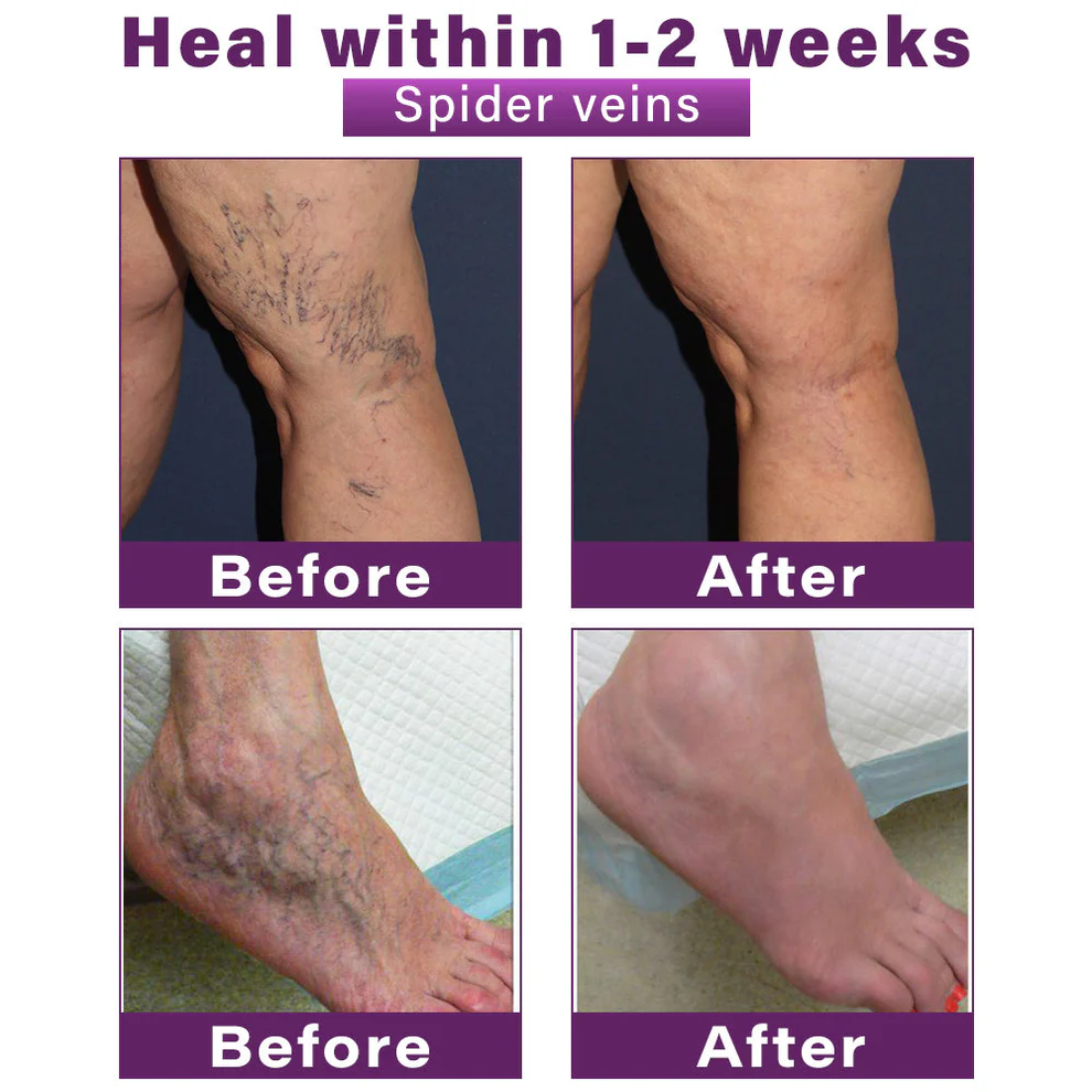 CVREOZ® Polidocanol Nano Varicose Vein Patch 9 CVREOZ® Polidocanol Nano Varicose Vein Patch