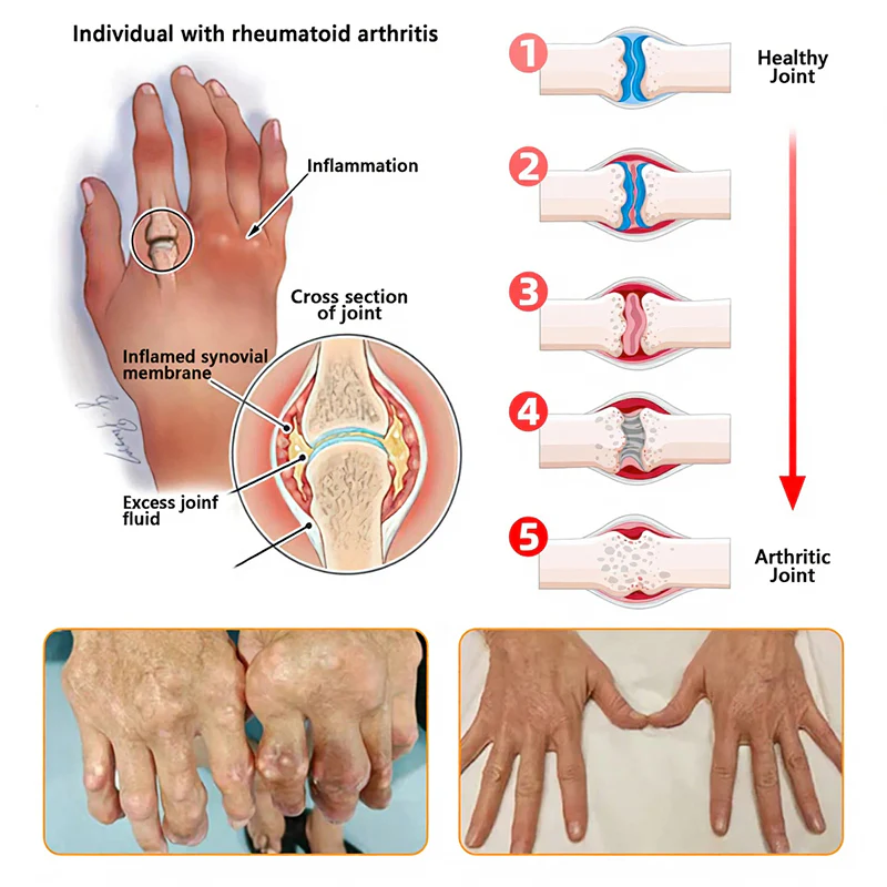 Jorondy® Bee Venom Pain-Relief Bone Healing Spray 6 Jorondy® Bee Venom Pain-Relief Bone Healing Spray