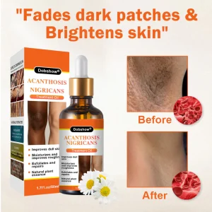 Dobshow® Acanthosis Nigricans Treatment Oil 12 Dobshow® Acanthosis Nigricans Treatment Oil