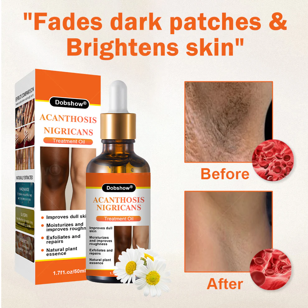 Dobshow® Acanthosis Nigricans Treatment Oil 2 Dobshow® Acanthosis Nigricans Treatment Oil