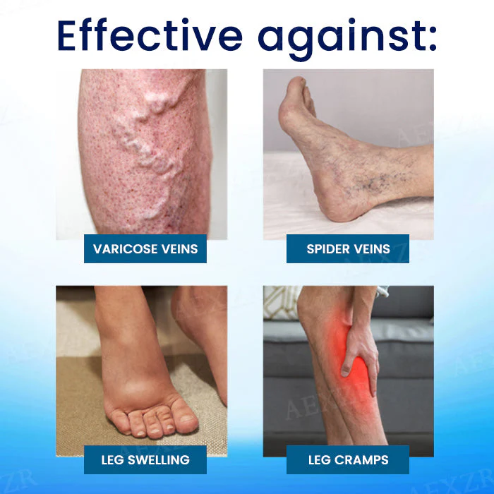 Cvreoz® Herbal Varicose Veins Treatment Spray 8 Cvreoz® Herbal Varicose Veins Treatment Spray