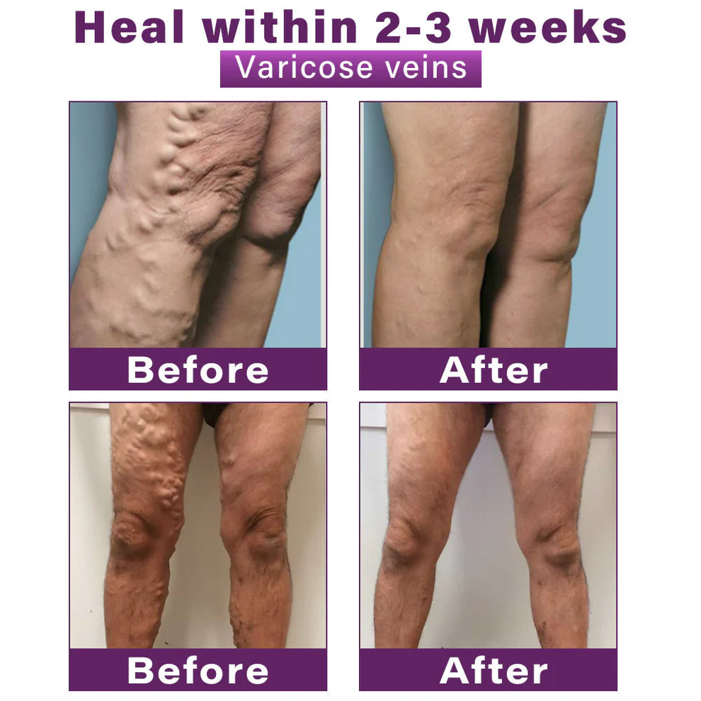 CVREOZ® Polidocanol Nano Varicose Vein Patch 8 CVREOZ® Polidocanol Nano Varicose Vein Patch