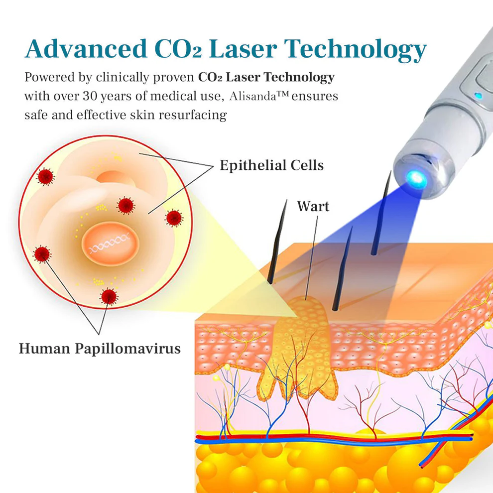 Alisanda™ LumeSkin Mole and Wart Removal Laser Pen