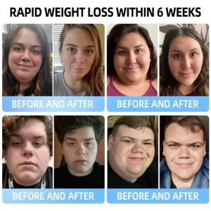 Croaie® NIDDK-Tirzepatide & Matrixyl 3000 Nano Microneedle Patch 23 Croaie® NIDDK-Tirzepatide & Matrixyl 3000 Nano Microneedle Patch