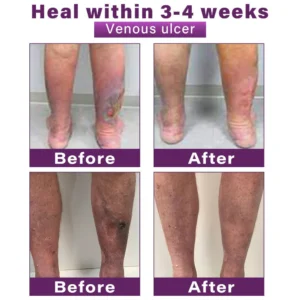 CVREOZ® Polidocanol Nano Varicose Vein Patch 15 CVREOZ® Polidocanol Nano Varicose Vein Patch