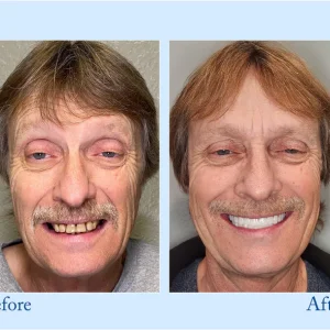 Smileasego™ - Premium Denture