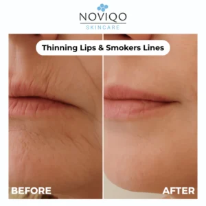 Noviqo™ – Anti-Wrinkle Freeze-Dried Nano-Silk Collagen System 13 Noviqo™ – Anti-Wrinkle Freeze-Dried Nano-Silk Collagen System