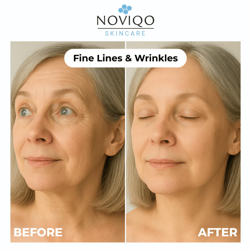 Noviqo™ – Anti-Wrinkle Freeze-Dried Nano-Silk Collagen System 6 Noviqo™ – Anti-Wrinkle Freeze-Dried Nano-Silk Collagen System