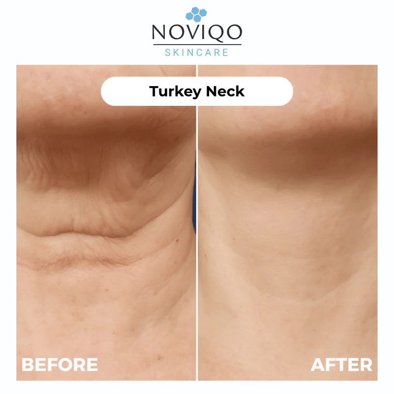 Noviqo™ – Anti-Wrinkle Freeze-Dried Nano-Silk Collagen System 5 Noviqo™ – Anti-Wrinkle Freeze-Dried Nano-Silk Collagen System