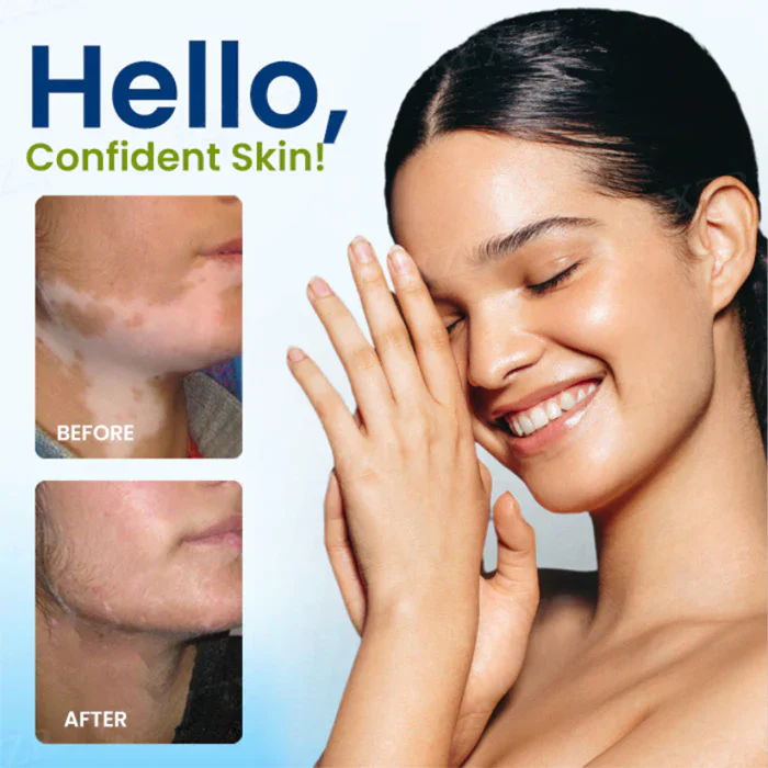 Cvreoz® Vitiligo Treatment Spray 9 Cvreoz® Vitiligo Treatment Spray