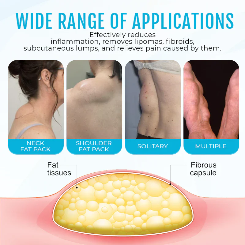 Cvreoz® Lipoma Removal Cream 7 Cvreoz® Lipoma Removal Cream