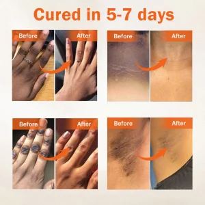 Dobshow® Acanthosis Nigricans Treatment Oil 19 Dobshow® Acanthosis Nigricans Treatment Oil