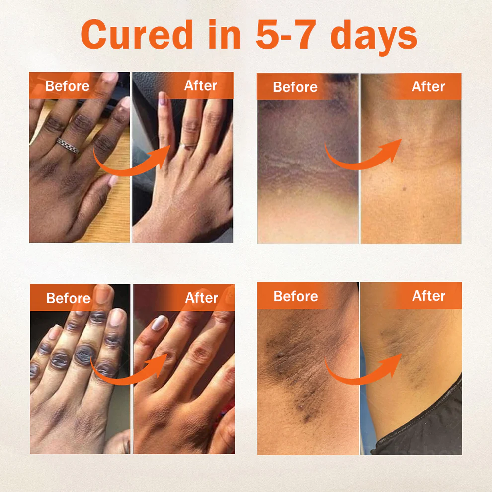 Dobshow® Acanthosis Nigricans Treatment Oil 9 Dobshow® Acanthosis Nigricans Treatment Oil