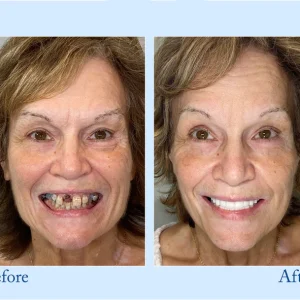 Smileasego™ - Premium Denture