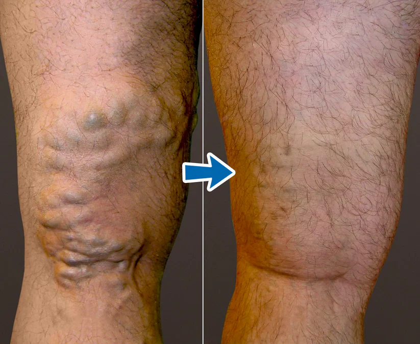 Cvreoz® VenoAid Varicose Solution Spray 3 Cvreoz® VenoAid Varicose Solution Spray