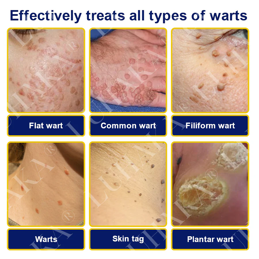 LUHAKA® SKIN TAG CRYO TREATMENT SPRAY ACE 6 LUHAKA® SKIN TAG CRYO TREATMENT SPRAY ACE