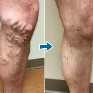 Cvreoz® VenoAid Varicose Solution Spray 7 Cvreoz® VenoAid Varicose Solution Spray