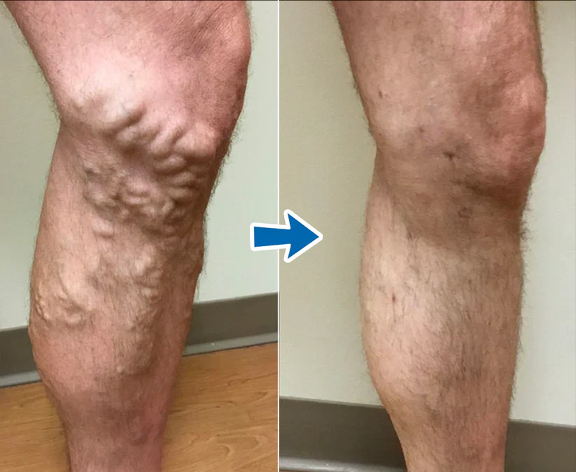 Cvreoz® VenoAid Varicose Solution Spray 2 Cvreoz® VenoAid Varicose Solution Spray