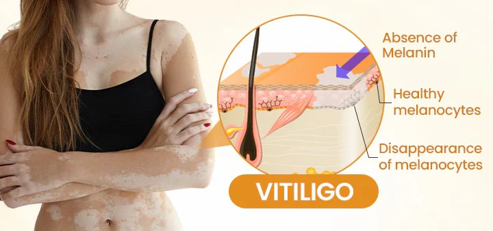 Newyuo® VitiCalm Bee Venom Cream 5 Newyuo® VitiCalm Bee Venom Cream