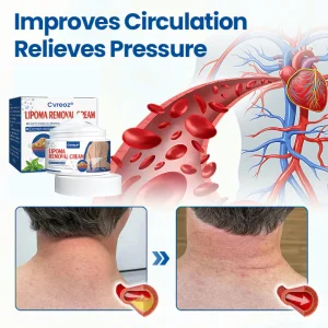 Cvreoz® Lipoma Removal Cream 14 Cvreoz® Lipoma Removal Cream