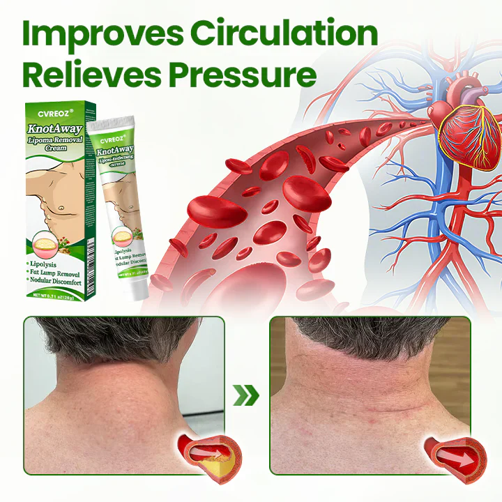 Cvreoz® KnotAway Lipoma Removal Cream 5 Cvreoz® KnotAway Lipoma Removal Cream