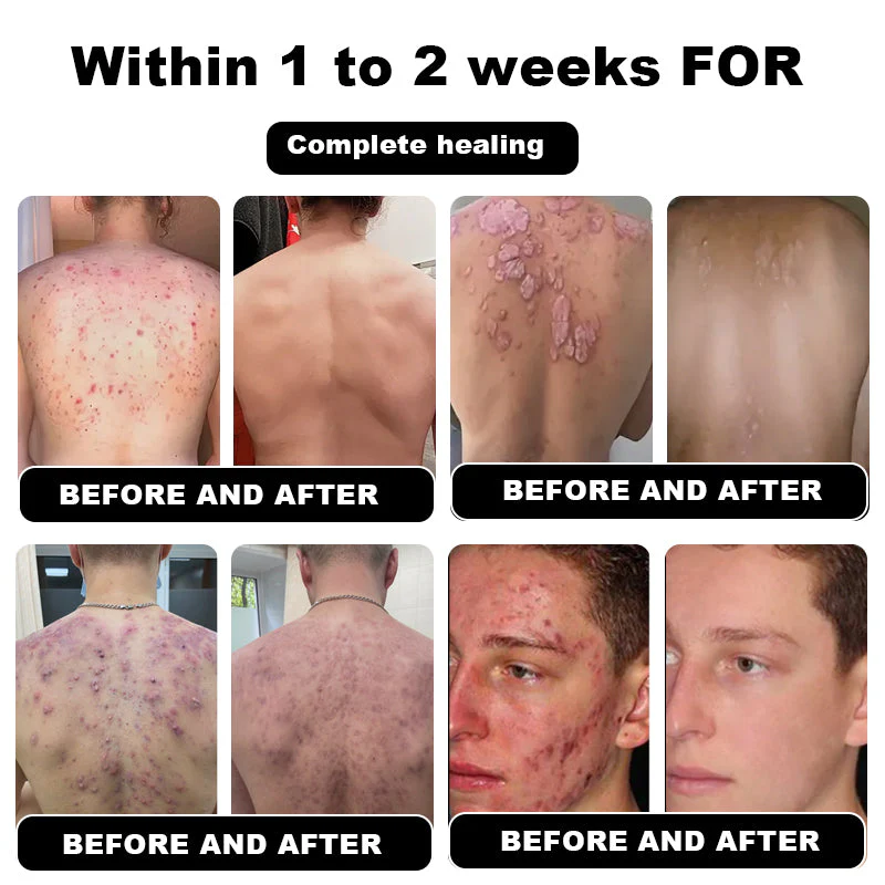 NESLEMY™ Psoriasis Cure Cream 9 NESLEMY™ Psoriasis Cure Cream