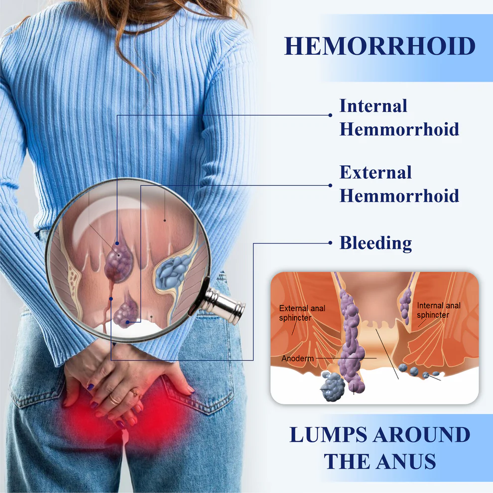 ATTDX® Advanced Relief Hemorrhoid Flushable Wipes 5 ATTDX® Advanced Relief Hemorrhoid Flushable Wipes