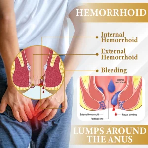 ATTDX® Apis Venom Hemorrhoid Cooling Spray 13 ATTDX® Apis Venom Hemorrhoid Cooling Spray