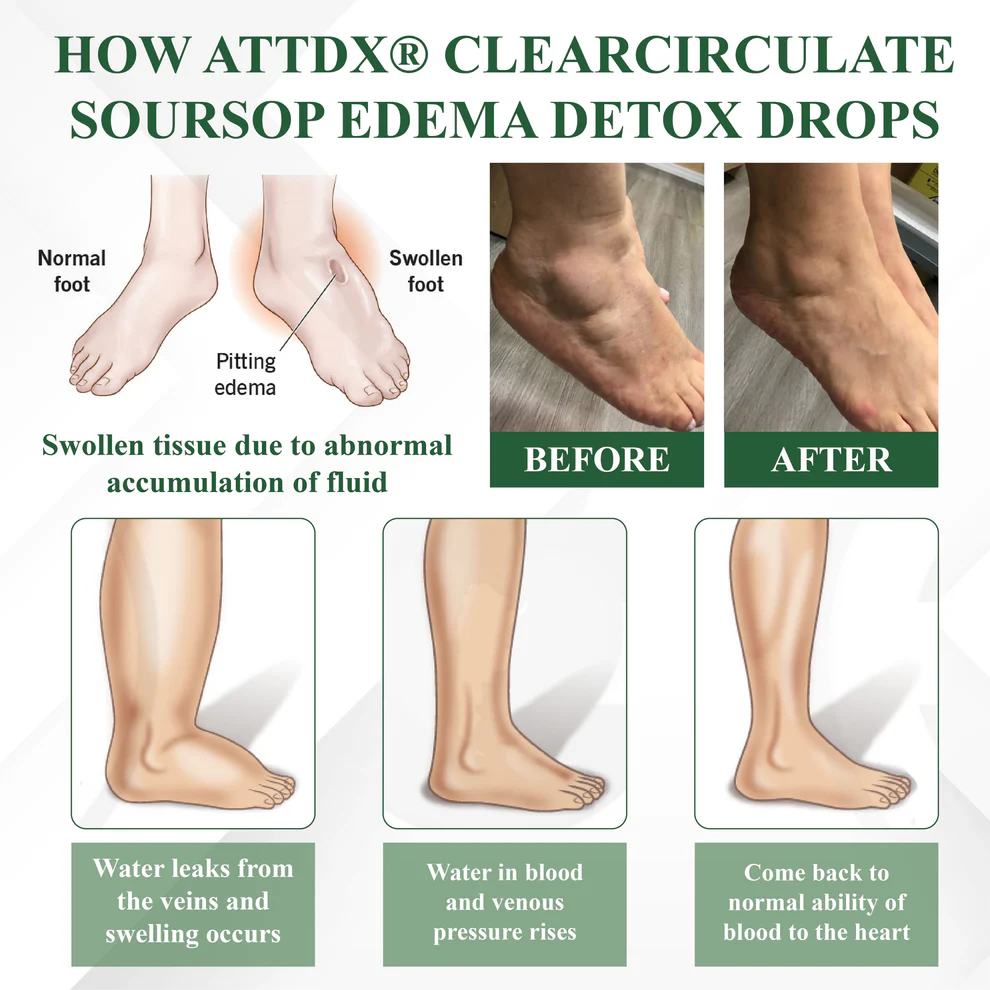 ATTDX® ClearCirculate Soursop Edema Detox Drops 5 ATTDX® ClearCirculate Soursop Edema Detox Drops