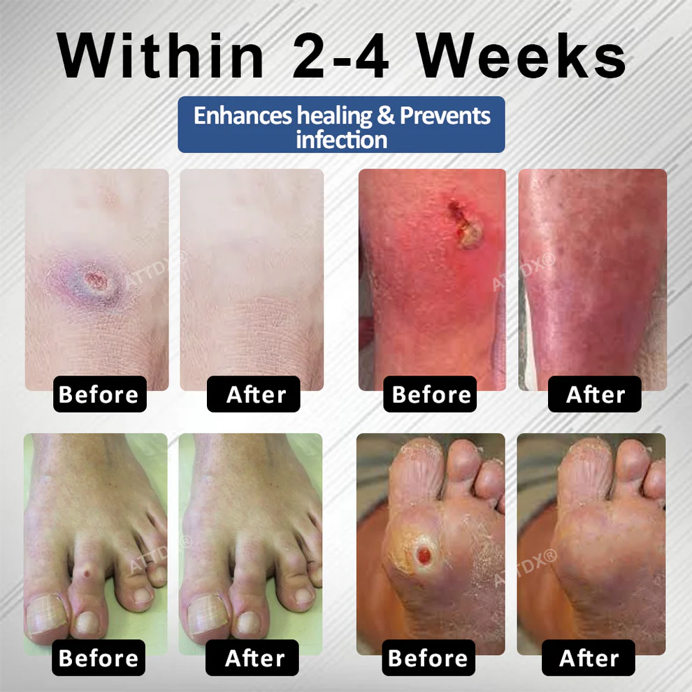 CVREOZ® Diabetes Foot Guard Fast Recovery Spray 8 CVREOZ® Diabetes Foot Guard Fast Recovery Spray