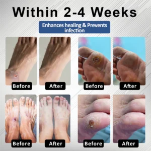 CVREOZ® Diabetes Foot Guard Fast Recovery Spray 18 CVREOZ® Diabetes Foot Guard Fast Recovery Spray