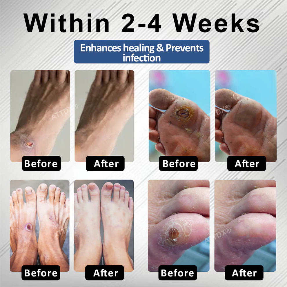 CVREOZ® Diabetes Foot Guard Fast Recovery Spray 7 CVREOZ® Diabetes Foot Guard Fast Recovery Spray