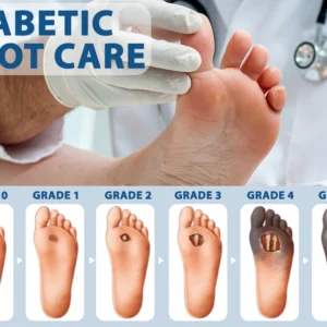 CVREOZ® Diabetes Foot Guard Fast Recovery Spray 23 CVREOZ® Diabetes Foot Guard Fast Recovery Spray