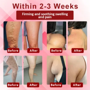 ATTDX® EdemaCare Lymphatic Drainage Massage Cream 9 ATTDX® EdemaCare Lymphatic Drainage Massage Cream