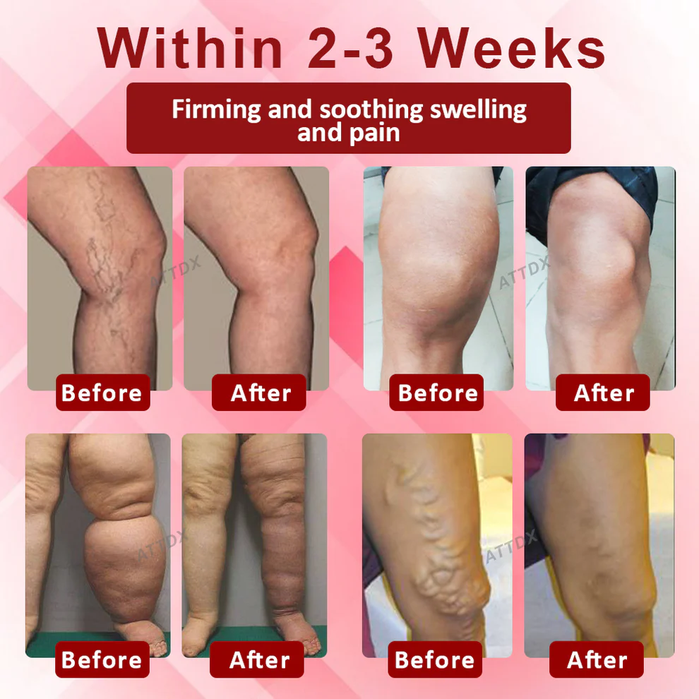 ATTDX® EdemaCare Lymphatic Drainage Massage Cream 5 ATTDX® EdemaCare Lymphatic Drainage Massage Cream