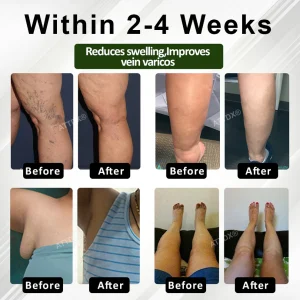 ATTDX® FluidEase Leg Therapy Edema Cream 16 ATTDX® FluidEase Leg Therapy Edema Cream