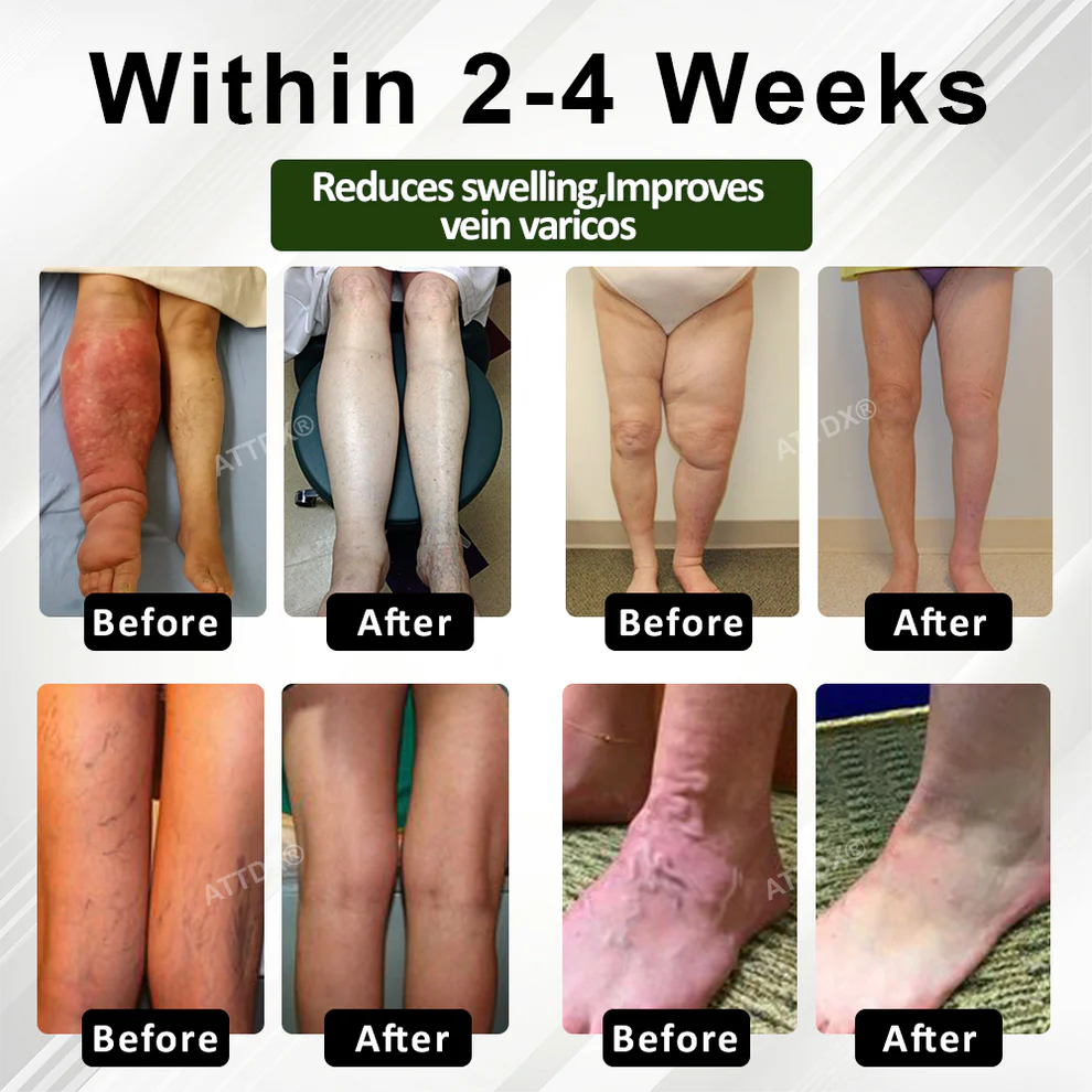 ATTDX® FluidEase Leg Therapy Edema Cream 4 ATTDX® FluidEase Leg Therapy Edema Cream