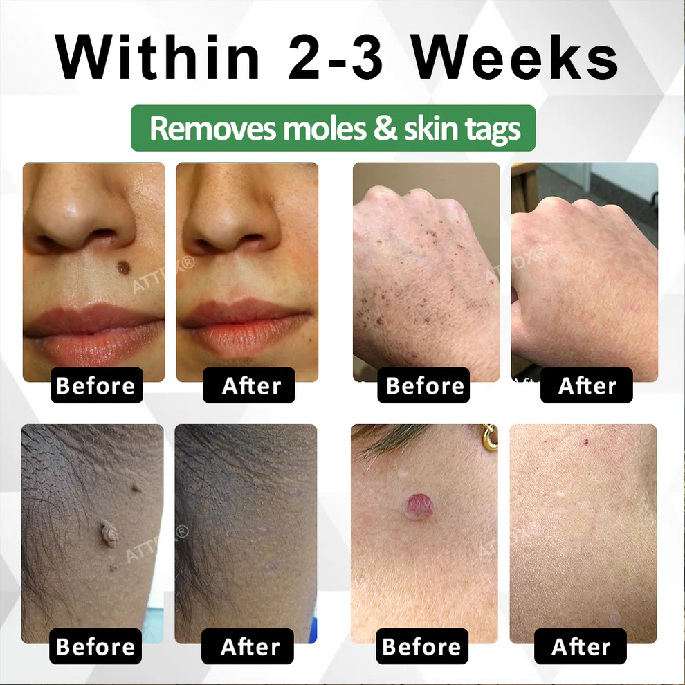 ATTDX® Herdle Shot Spot & Mole Correct Serum 3 ATTDX® Herdle Shot Spot & Mole Correct Serum