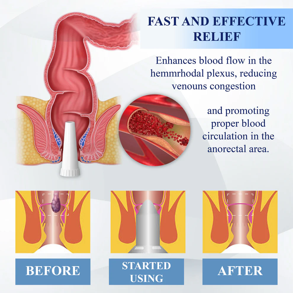 ATTDX® Medical Hemorrhoid Herbal Gel with Applicator 3 ATTDX® Medical Hemorrhoid Herbal Gel with Applicator