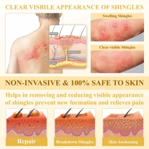 ATTDX® NervoSoothe Shingles Healing Ointment 17 ATTDX® NervoSoothe Shingles Healing Ointment