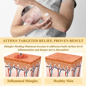 ATTDX® NervoSoothe Shingles Healing Ointment 16 ATTDX® NervoSoothe Shingles Healing Ointment