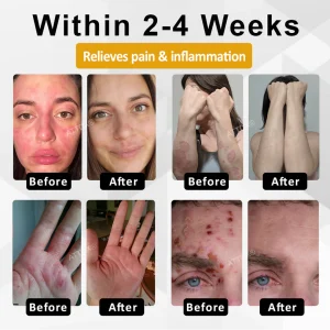 ATTDX® NervoSoothe Shingles Healing Ointment 12 ATTDX® NervoSoothe Shingles Healing Ointment