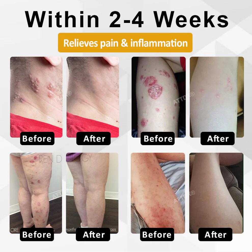 ATTDX® NervoSoothe Shingles Healing Ointment 2 ATTDX® NervoSoothe Shingles Healing Ointment