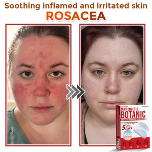 GFOUK® MicroNeedle Botanic Skin Tag Removal Patch 20 GFOUK® MicroNeedle Botanic Skin Tag Removal Patch