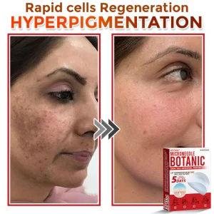 GFOUK® MicroNeedle Botanic Skin Tag Removal Patch 18 GFOUK® MicroNeedle Botanic Skin Tag Removal Patch