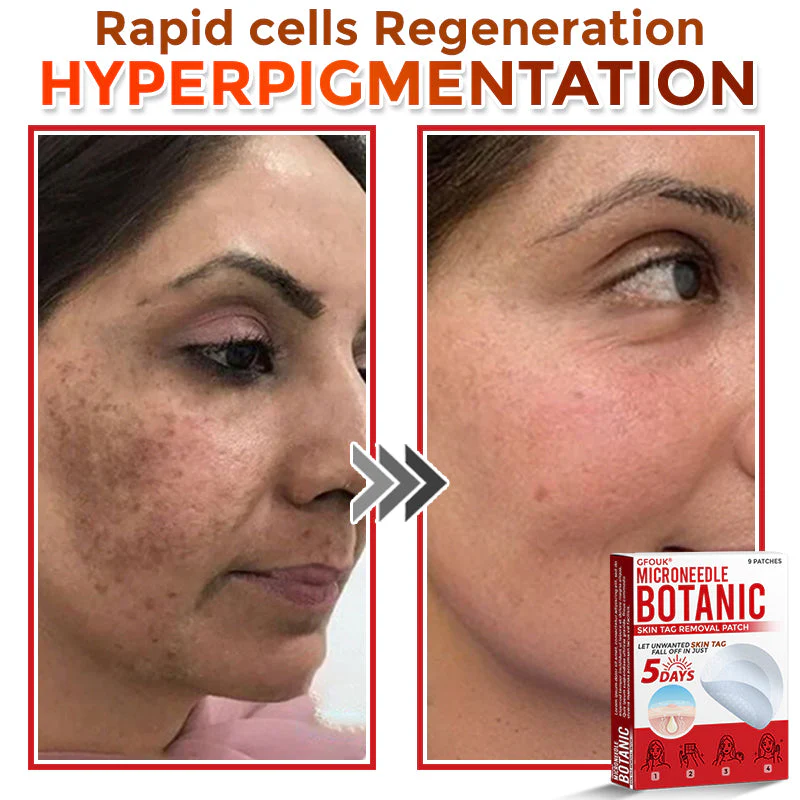 GFOUK® MicroNeedle Botanic Skin Tag Removal Patch 7 GFOUK® MicroNeedle Botanic Skin Tag Removal Patch