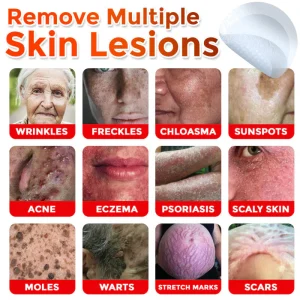 GFOUK® MicroNeedle Botanic Skin Tag Removal Patch 23 GFOUK® MicroNeedle Botanic Skin Tag Removal Patch